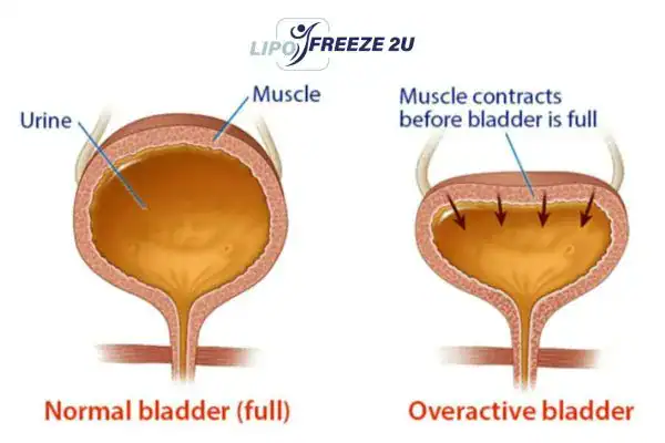diagram of overactive bladder treatment Bushey