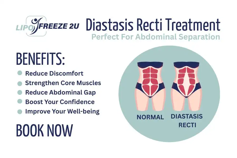 How Long Will It Take to See Improvements in Diastasis Recti Bushey
