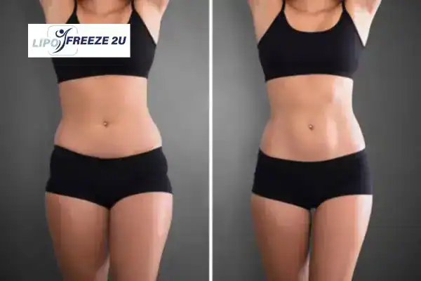 How Can LIPO FREEZE 2U Support Your Post-Pregnancy Body Recovery Bushey?