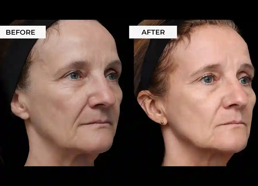 How Many RF Microneedling Sessions Will You Need to See a Difference Bushey?